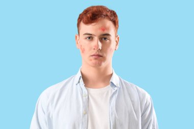 Mavi arka planda sivilceli genç bir çocuk.