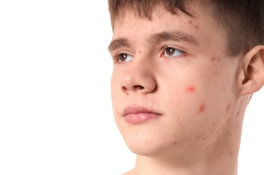 Beyaz arka planda sivilce sorunu olan genç çocuk, yakın plan.