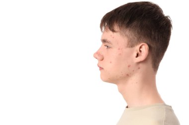 Beyaz arka planda sivilceli genç çocuk, yakın plan.