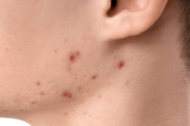 Beyaz arka planda sivilceli genç çocuk, yakın plan.