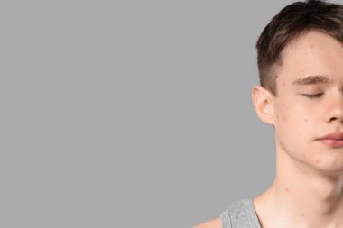 Gri arka planda sivilceli genç çocuk, yakın plan.