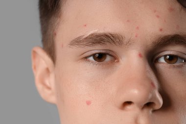 Gri arka planda sivilceli genç çocuk, yakın plan.