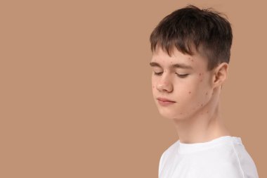 Bej arka planda sivilceli genç çocuk, yakın plan.