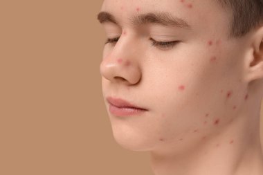 Bej arka planda sivilceli genç çocuk, yakın plan.