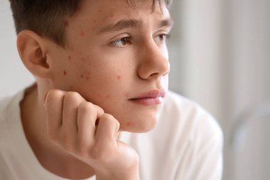 Sivilceli genç çocuk banyoda, yakın plan.