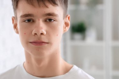 Banyoda sivilceleri olan genç bir çocuk, yakın plan.