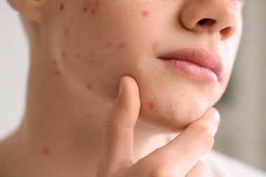 Sivilceli genç çocuk banyoda, yakın plan.