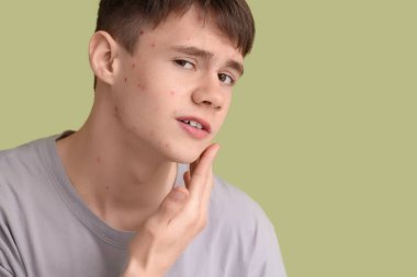 Yeşil arka planda sivilceli genç çocuk, yakın plan.