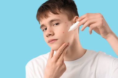 Sivilceli genç çocuk mavi arka planda krem sürüyor, yakın plan.