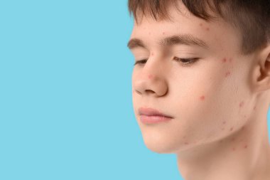 Mavi arka planda sivilceli genç çocuk, yakın plan.