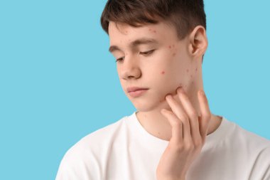 Mavi arka planda sivilceli genç çocuk, yakın plan.