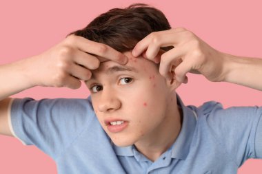 Pembe arka planda sivilceleri olan genç bir çocuk, yakın plan.