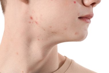 Beyaz arka planda sivilceli genç çocuk, yakın plan.