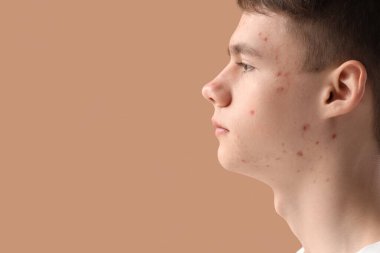 Bej arka planda sivilceli genç çocuk, yakın plan.