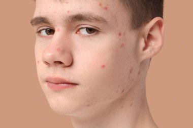 Bej arka planda sivilceli genç çocuk, yakın plan.