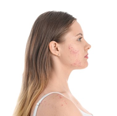 Beyaz arka planda sivilce sorunu olan genç kız, yakın plan.