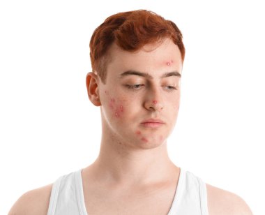 Beyaz arka planda sivilceli genç bir çocuk.