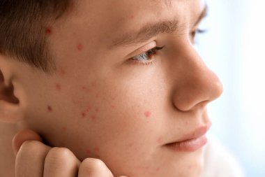 Sivilceli genç çocuk banyoda, yakın plan.