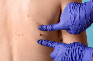 Dermatolog, kadının sırtındaki beni mavi arka planda inceliyor.