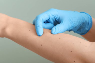 Dermatolog, kadının kolundaki benleri yeşil arka planla karşılaştırıyor.