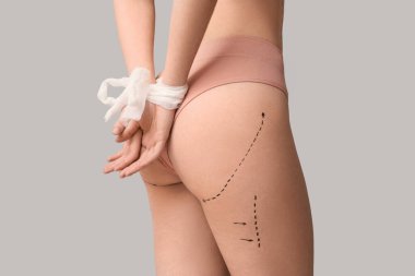 Vücudunda izler olan ve elleri arka planda olan genç bir kadın, yakın plan. Estetik ameliyat konsepti