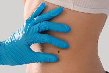 Dermatolog, kadının karnındaki benle ışık arkaplanını karşılaştırıyor.