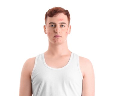 Beyaz arka planda sivilceli genç bir çocuk.