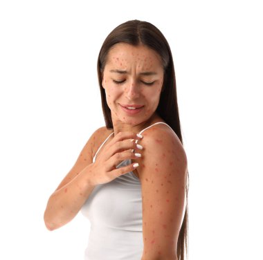 Beyaz arka planı tırmalayan suçiçeği hastası genç bir kadın.