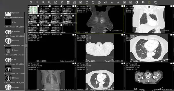 Frankfurt Germany January 2024 Computed Tomography Lung Illness Fibrosis — Stock Photo, Image