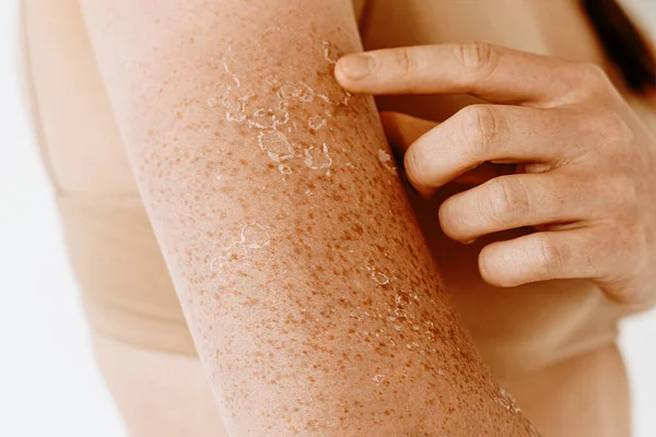 Peeling skin with freckles after sunburn, dermatological problems on female arms and shoulders, skin care concept, sensitive skin . The girl applies a moisturizing cream to the burnt and peeling skin