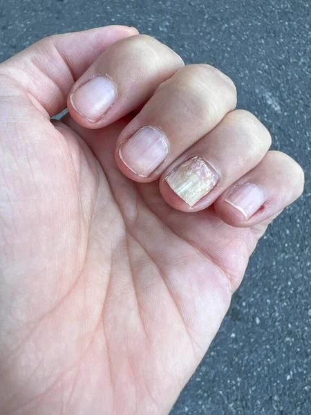 白人女性の手指に爪真菌感染症を閉じます 爪に真菌感染症 爪筋症の女性の手の指 健康管理だ 病気の女性の体の一部 — ストック写真
