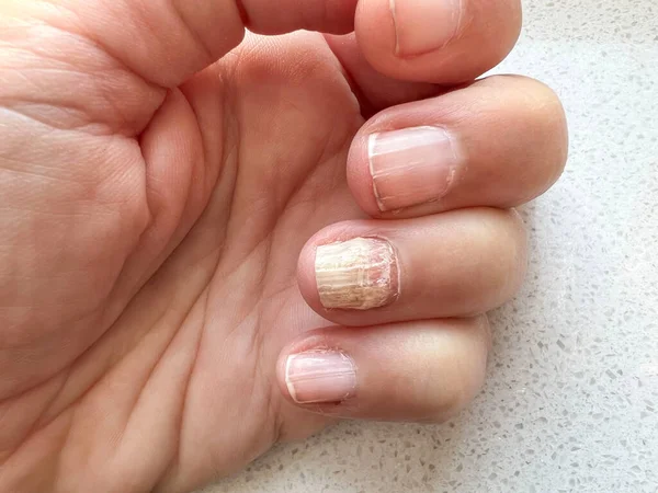 白人女性の手指に爪真菌感染症を閉じます 爪に真菌感染症 爪筋症の女性の手の指 健康管理だ 病気の女性の体の一部 ロイヤリティフリーのストック画像