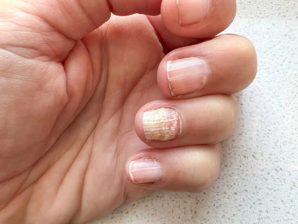 白人女性の手指に爪真菌感染症を閉じます 爪に真菌感染症 爪筋症の女性の手の指 健康管理だ 病気の女性の体の一部 — ストック写真