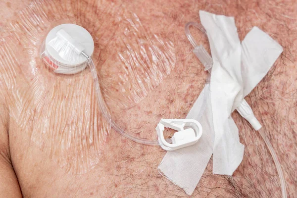 Putki Venttiili Yhteinen Yhteys Laskimoon Nesteitä Injektionesteisiin Implantoitavaan Porttiin Kemoterapiaa — kuvapankkivalokuva