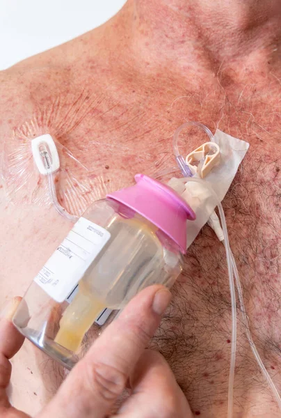 Butelka Dożylna Stosowana Chemioterapii Rurka Zaworem Połączeniem Stawów Wstrzyknięć Płynów — Zdjęcie stockowe