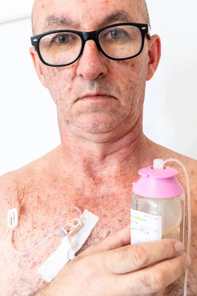 Mies Osoittaa Putken Venttiili Saranoitu Yhteys Laskimonsisäisen Nesteen Injektioita Implantoitu — kuvapankkivalokuva