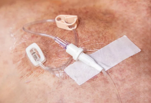 Tube Met Klep Gezamenlijke Verbinding Voor Intraveneuze Vloeistoffen Injecties Aan — Stockfoto