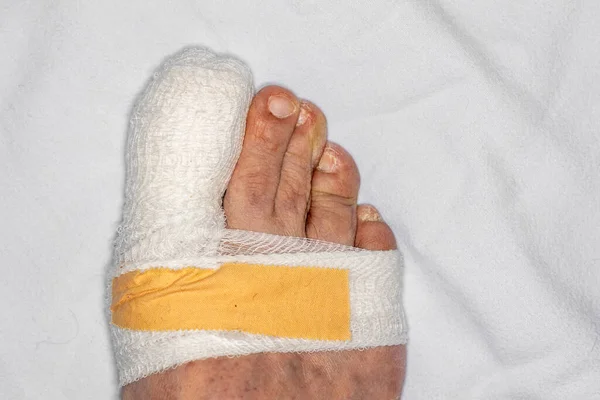 Крупный План Правой Ноги Человека Раненым Большим Пальцем Ноги Заверните — стоковое фото