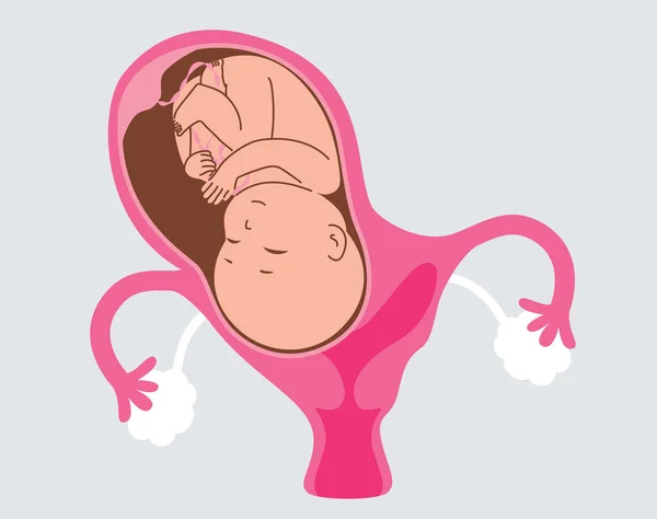 妊娠期双核子宫的病媒图解 一个有胎儿的子宫和第二个腔是空的 并与隔膜分离 — 图库矢量图片