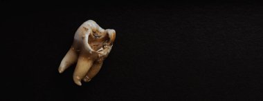 Siyah arka planda diş çürüğü. Çürük bir dişin makro aşısı dişçiyi çıkardıktan sonra kök salana kadar. Gerçek diş anatomisi ilgisizlikten kaynaklanıyor. Siyah kağıttaki diş dokusunun üst görüntüsü. Diş bakımı.