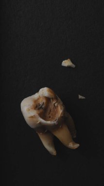 Siyah arka planda diş çürüğü. Çürük bir dişin makro aşısı dişçiyi çıkardıktan sonra kök salana kadar. Gerçek diş anatomisi ilgisizlikten kaynaklanıyor. Siyah kağıttaki diş dokusunun üst görüntüsü. Diş bakımı.
