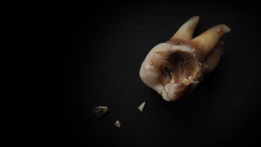 Siyah arka planda diş çürüğü. Çürük bir dişin makro aşısı dişçiyi çıkardıktan sonra kök salana kadar. Gerçek diş anatomisi ilgisizlikten kaynaklanıyor. Siyah kağıttaki diş dokusunun üst görüntüsü. Diş bakımı.