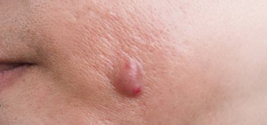 Bacterial skin infection. Big Acne Cyst Abscess or Ulcer Swollen area within face skin tissue. Containing accumulation of pus and blood. Macro shot of Acne or Dermatitis near mouth on face. Skincare.