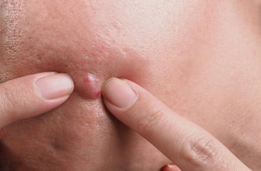 Bacterial skin infection. Big Acne Cyst Abscess or Ulcer Swollen area within face skin tissue. Containing accumulation of pus and blood. Macro shot of Acne or Dermatitis near mouth on face. Skincare.