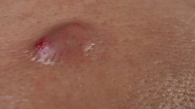 Bacterial skin infection. Big Acne Cyst Abscess or Ulcer Swollen area within face skin tissue. Containing accumulation of pus and blood. Macro shot of Acne or Dermatitis near mouth on face. Skincare.