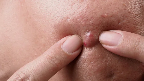 Bacterial skin infection. Big Acne Cyst Abscess or Ulcer Swollen area within face skin tissue. Containing accumulation of pus and blood. Macro shot of Acne or Dermatitis near mouth on face. Skincare.
