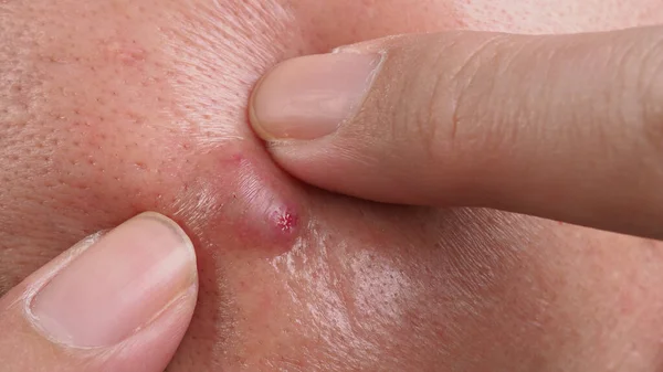 Bacterial skin infection. Big Acne Cyst Abscess or Ulcer Swollen area within face skin tissue. Containing accumulation of pus and blood. Macro shot of Acne or Dermatitis near mouth on face. Skincare.