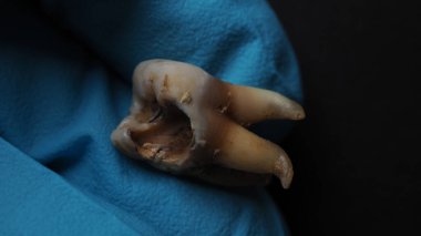 Tooth decay and dentist hand with glove and black background. Macro shot of a decayed teeth till root after extraction of dentist. Real tooth anatomy due lack of dental care. Top view of caries teeth