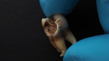 Tooth decay and dentist hand with glove and black background. Macro shot of a decayed teeth till root after extraction of dentist. Real tooth anatomy due lack of dental care. Top view of caries teeth
