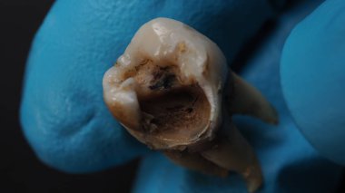 Tooth decay and dentist hand with glove and black background. Macro shot of a decayed teeth till root after extraction of dentist. Real tooth anatomy due lack of dental care. Top view of caries teeth